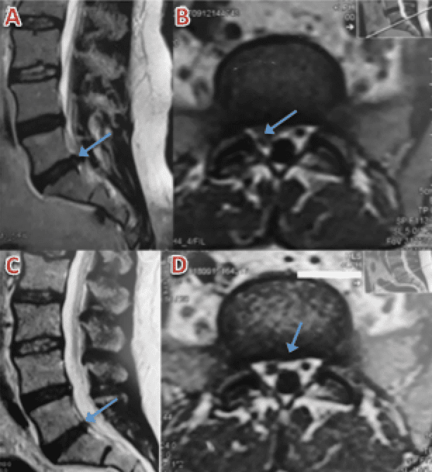 Mri Of Bulging Disc Lower Lumbar